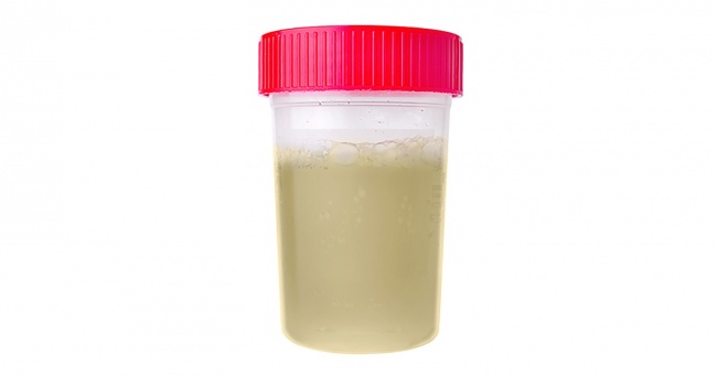Nước tiểu trong veo cũng không tốt, tại sao? Nước tiểu trong veo cũng không tốt, tại sao?