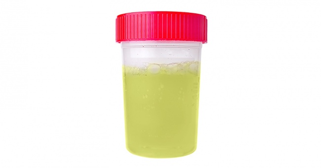 Nước tiểu trong veo cũng không tốt, tại sao? Nước tiểu trong veo cũng không tốt, tại sao?