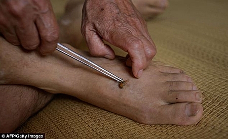 Một phụ nữ tử vong do dùng ong châm cứu Một phụ nữ tử vong do dùng ong châm cứu