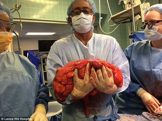 Tưởng béo do bụng bia, người đàn ông tá hoả phát hiện khối u nặng 13kg trong bụng Tưởng béo do bụng bia, người đàn ông tá hoả phát hiện khối u nặng 13kg trong bụng