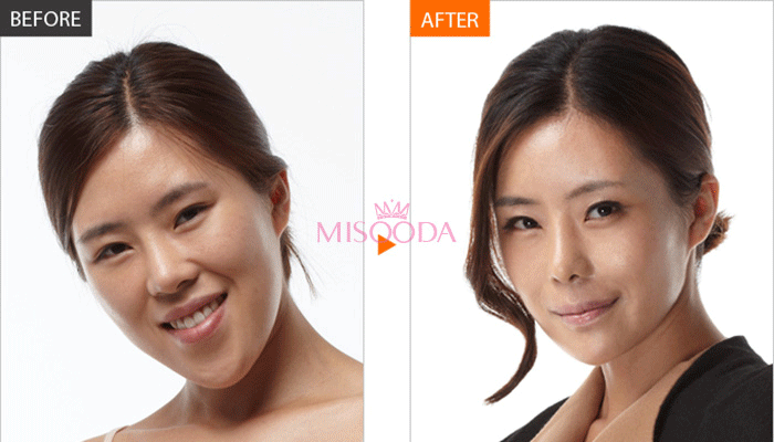3 loại hình 'dao kéo' tại Mỹ khiến các thanh niên ở 'thiên đường thẩm mỹ' như Hàn cũng phải ghen tị 3 loại hình 'dao kéo' tại Mỹ khiến các thanh niên ở 'thiên đường thẩm mỹ' như Hàn cũng phải ghen tị
