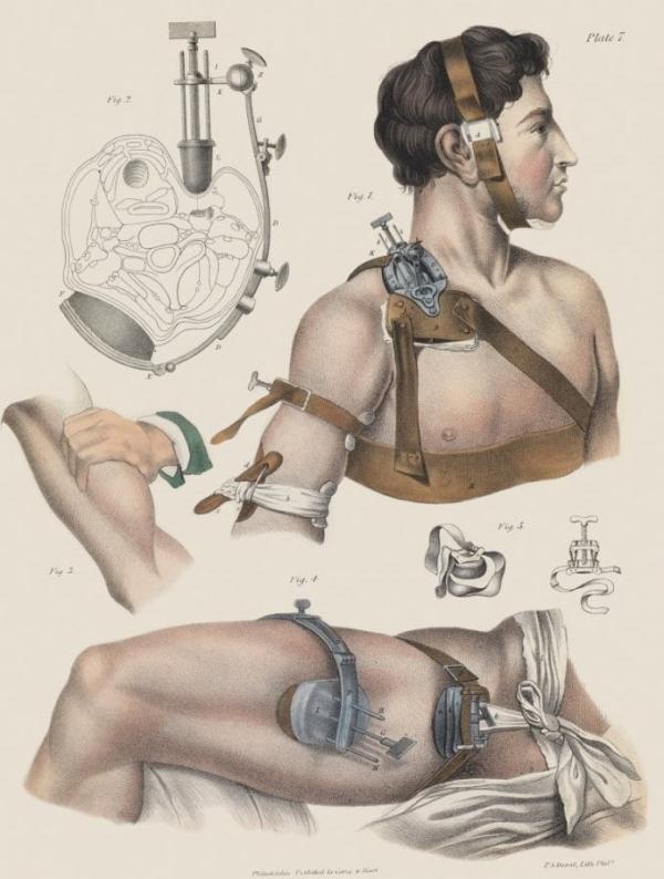 Bộ sưu tập tranh minh họa sống động về giai đoạn y học phẫu thuật thế kỷ XV - XIX Bộ sưu tập tranh minh họa sống động về giai đoạn y học phẫu thuật thế kỷ XV - XIX