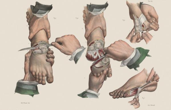 Bộ sưu tập tranh minh họa sống động về giai đoạn y học phẫu thuật thế kỷ XV - XIX Bộ sưu tập tranh minh họa sống động về giai đoạn y học phẫu thuật thế kỷ XV - XIX