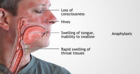 anaphylaxis symptoms food allergy e1435156719978