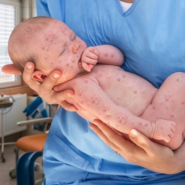 Nghiên cứu trên hơn 650.000 trẻ em đã khẳng định vắc-xin MMR KHÔNG gây ra bệnh tự kỷ Nghiên cứu trên hơn 650.000 trẻ em đã khẳng định vắc-xin MMR KHÔNG gây ra bệnh tự kỷ