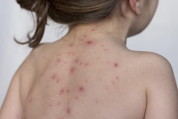 Nam thanh niên anti-vaxxer phải nghỉ học, dang dở ước mơ chơi bóng do mắc bệnh thủy đậu Nam thanh niên anti-vaxxer phải nghỉ học, dang dở ước mơ chơi bóng do mắc bệnh thủy đậu