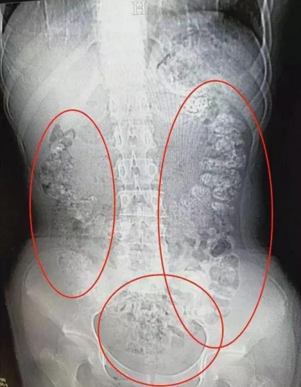 Phát hiện hơn 100 viên trân châu trong bụng cô bé 14 tuổi do thói quen uống trà sữa quá nhiều Phát hiện hơn 100 viên trân châu trong bụng cô bé 14 tuổi do thói quen uống trà sữa quá nhiều