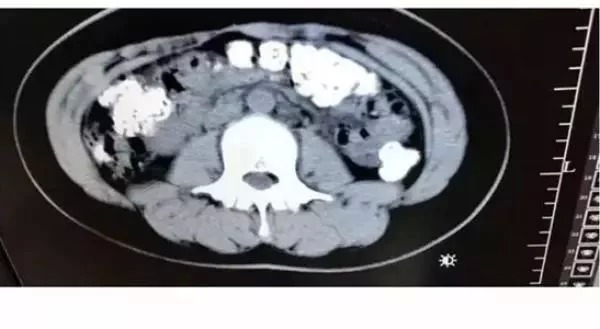 Phát hiện hơn 100 viên trân châu trong bụng cô bé 14 tuổi do thói quen uống trà sữa quá nhiều Phát hiện hơn 100 viên trân châu trong bụng cô bé 14 tuổi do thói quen uống trà sữa quá nhiều