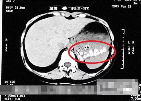 Phát hiện hơn 100 viên trân châu trong bụng cô bé 14 tuổi do thói quen uống trà sữa quá nhiều Phát hiện hơn 100 viên trân châu trong bụng cô bé 14 tuổi do thói quen uống trà sữa quá nhiều