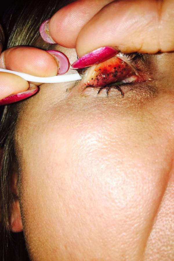Không tẩy trang sau khi dùng mascara trong suốt 25 năm khiến một phụ nữ có nguy cơ bị mù Không tẩy trang sau khi dùng mascara trong suốt 25 năm khiến một phụ nữ có nguy cơ bị mù
