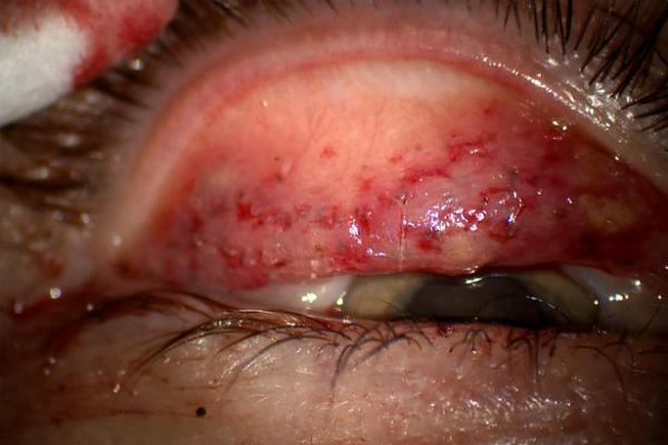 Không tẩy trang sau khi dùng mascara trong suốt 25 năm khiến một phụ nữ có nguy cơ bị mù Không tẩy trang sau khi dùng mascara trong suốt 25 năm khiến một phụ nữ có nguy cơ bị mù