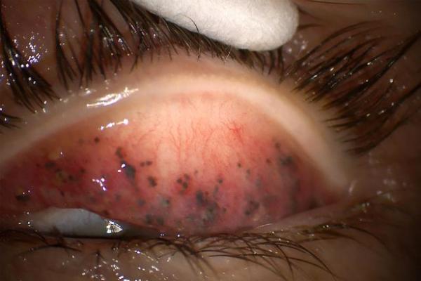 Không tẩy trang sau khi dùng mascara trong suốt 25 năm khiến một phụ nữ có nguy cơ bị mù Không tẩy trang sau khi dùng mascara trong suốt 25 năm khiến một phụ nữ có nguy cơ bị mù
