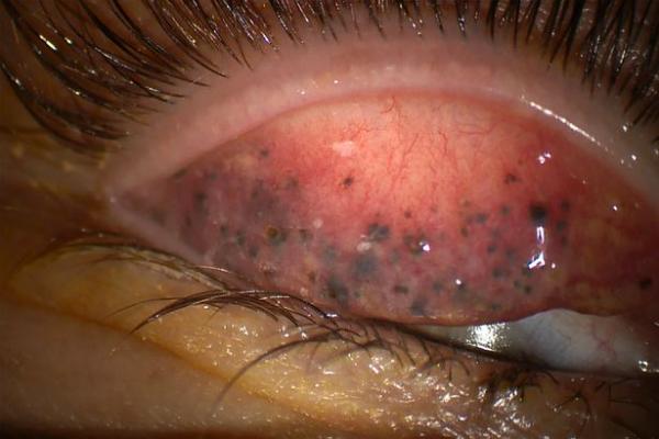 Không tẩy trang sau khi dùng mascara trong suốt 25 năm khiến một phụ nữ có nguy cơ bị mù Không tẩy trang sau khi dùng mascara trong suốt 25 năm khiến một phụ nữ có nguy cơ bị mù