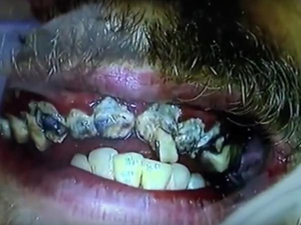 20 năm không chịu đánh răng, ai cũng sốc khi thanh niên này đến gặp nha sĩ 20 năm không chịu đánh răng, ai cũng sốc khi thanh niên này đến gặp nha sĩ