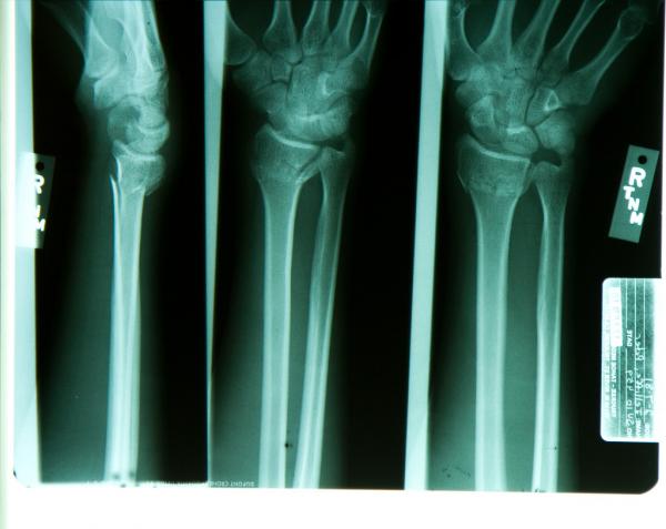 Không siêu việt như X-Men nhưng những người này cũng sở hữu gen di truyền hiếm có Không siêu việt như X-Men nhưng những người này cũng sở hữu gen di truyền hiếm có