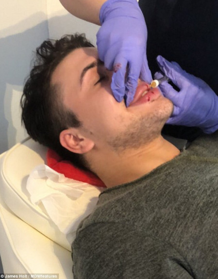 Chàng trai chi 430 triệu VNĐ để có môi tều giống Kylie Jenner nhưng kết quả sai quá sai Chàng trai chi 430 triệu VNĐ để có môi tều giống Kylie Jenner nhưng kết quả sai quá sai