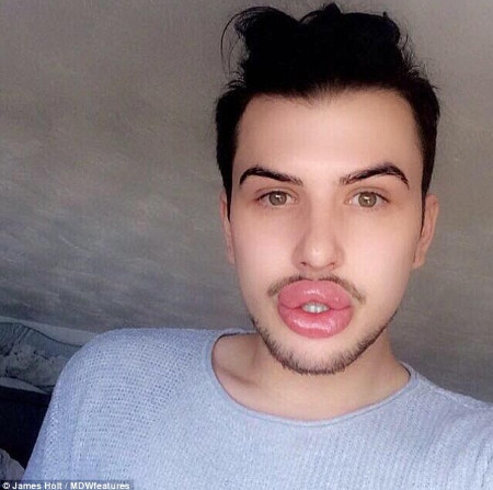 Chàng trai chi 430 triệu VNĐ để có môi tều giống Kylie Jenner nhưng kết quả sai quá sai Chàng trai chi 430 triệu VNĐ để có môi tều giống Kylie Jenner nhưng kết quả sai quá sai