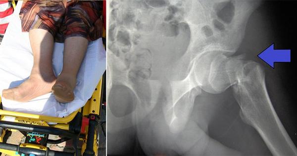 10 hành động tưởng vớ vẩn nhưng có thể khiến bạn xui xẻo chấn thương, nhập viện như chơi 10 hành động tưởng vớ vẩn nhưng có thể khiến bạn xui xẻo chấn thương, nhập viện như chơi