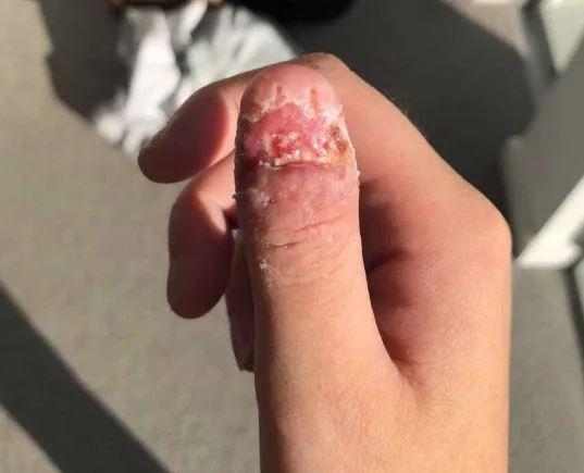 Thường xuyên cắn móng tay, cô gái trẻ bàng hoàng khi biết mình mắc phải bệnh ung thư hiếm gặp Thường xuyên cắn móng tay, cô gái trẻ bàng hoàng khi biết mình mắc phải bệnh ung thư hiếm gặp