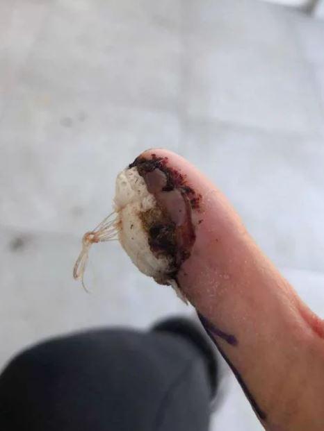 Thường xuyên cắn móng tay, cô gái trẻ bàng hoàng khi biết mình mắc phải bệnh ung thư hiếm gặp Thường xuyên cắn móng tay, cô gái trẻ bàng hoàng khi biết mình mắc phải bệnh ung thư hiếm gặp