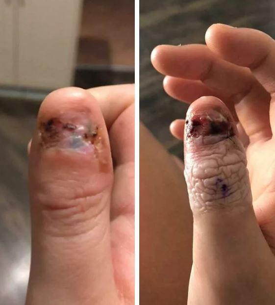 Thường xuyên cắn móng tay, cô gái trẻ bàng hoàng khi biết mình mắc phải bệnh ung thư hiếm gặp Thường xuyên cắn móng tay, cô gái trẻ bàng hoàng khi biết mình mắc phải bệnh ung thư hiếm gặp