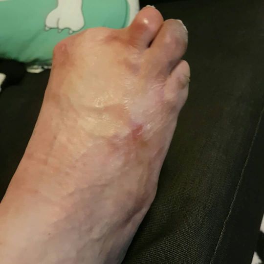Từ 5 ngón chân thành... không ngón nào - Hậu quả tai hại sau một lần massage cho cá rỉa chân Từ 5 ngón chân thành... không ngón nào - Hậu quả tai hại sau một lần massage cho cá rỉa chân