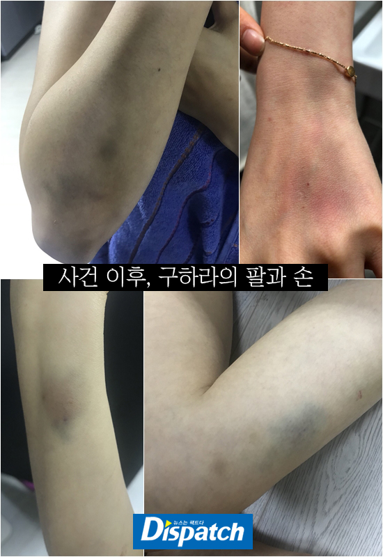 Lộ ảnh Goo Hara bầm tím khắp người, bị bạn trai hành hung đến mức 'xuất huyết tử cung' Lộ ảnh Goo Hara bầm tím khắp người, bị bạn trai hành hung đến mức 'xuất huyết tử cung'