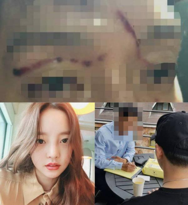 Lộ ảnh Goo Hara bầm tím khắp người, bị bạn trai hành hung đến mức 'xuất huyết tử cung' Lộ ảnh Goo Hara bầm tím khắp người, bị bạn trai hành hung đến mức 'xuất huyết tử cung'