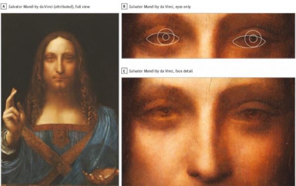 Hóa ra danh họa Leonardo da Vinci bị... lé do mắc chứng rối loạn thị lực Hóa ra danh họa Leonardo da Vinci bị... lé do mắc chứng rối loạn thị lực