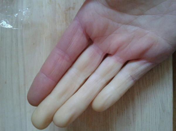 Nỗi khổ mà chỉ có những người gặp phải hội chứng Raynaud mới hiểu được Nỗi khổ mà chỉ có những người gặp phải hội chứng Raynaud mới hiểu được