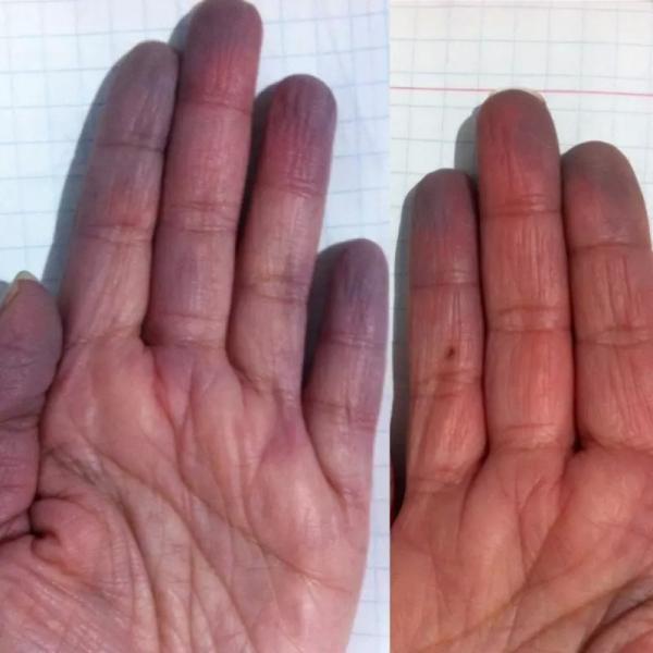 Nỗi khổ mà chỉ có những người gặp phải hội chứng Raynaud mới hiểu được Nỗi khổ mà chỉ có những người gặp phải hội chứng Raynaud mới hiểu được