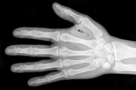 Nhiều công ty Anh gây tranh cãi vì muốn cấy microchip vào người nhân viên Nhiều công ty Anh gây tranh cãi vì muốn cấy microchip vào người nhân viên