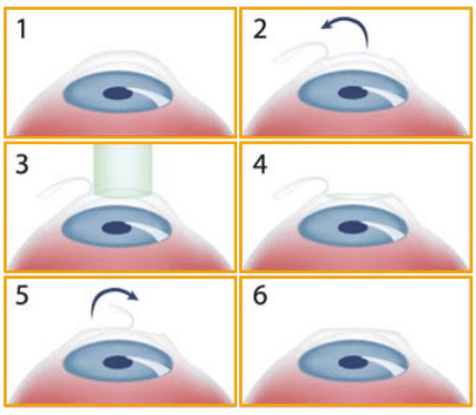 Nữ MC nổi tiếng của FOX TV tự tử sau khi phẫu thuật Lasik SMILE để lấy lại thị lực Nữ MC nổi tiếng của FOX TV tự tử sau khi phẫu thuật Lasik SMILE để lấy lại thị lực