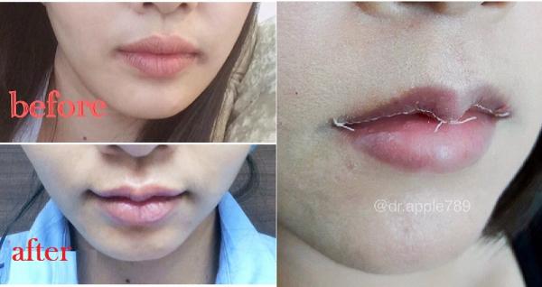 6 thủ thuật thẩm mỹ được các thần tượng châu Á ưa chuộng 6 thủ thuật thẩm mỹ được các thần tượng châu Á ưa chuộng