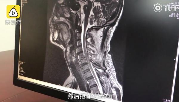 Mừng chủ mới về, em chó phấn khích nhảy từ nóc nhà xuống khiến chủ bị gãy cổ Mừng chủ mới về, em chó phấn khích nhảy từ nóc nhà xuống khiến chủ bị gãy cổ
