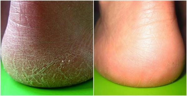 10 tips sau đây sẽ giúp bạn nhanh chóng 'tạm biệt' làn da chai sạn 10 tips sau đây sẽ giúp bạn nhanh chóng 'tạm biệt' làn da chai sạn