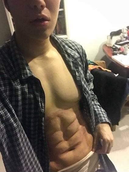 Khỏi cần tập gym vẫn có thể sở hữu body sáu múi chuẩn manly nhờ... dao kéo Khỏi cần tập gym vẫn có thể sở hữu body sáu múi chuẩn manly nhờ... dao kéo
