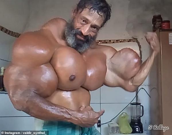 Ông chú Brazil liều mạng tiêm synthol để có cơ bắp 'khủng' như Hulk Ông chú Brazil liều mạng tiêm synthol để có cơ bắp 'khủng' như Hulk