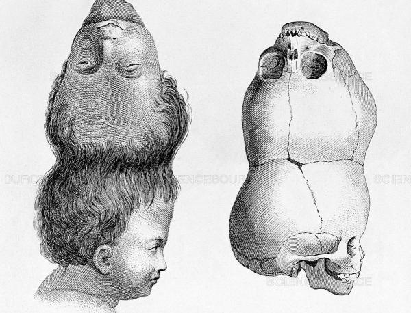 Sinh đôi ký sinh - Sự thật về hội chứng kỳ quái khởi nguồn cho những thước phim kinh dị Sinh đôi ký sinh - Sự thật về hội chứng kỳ quái khởi nguồn cho những thước phim kinh dị