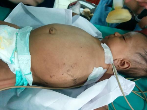 Sinh đôi ký sinh - Sự thật về hội chứng kỳ quái khởi nguồn cho những thước phim kinh dị Sinh đôi ký sinh - Sự thật về hội chứng kỳ quái khởi nguồn cho những thước phim kinh dị