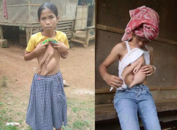 Sinh đôi ký sinh - Sự thật về hội chứng kỳ quái khởi nguồn cho những thước phim kinh dị Sinh đôi ký sinh - Sự thật về hội chứng kỳ quái khởi nguồn cho những thước phim kinh dị