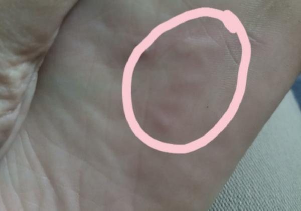 Cô gái hoảng sợ phát hiện bị ký sinh trùng chui vào chân khi đi bộ trên bãi biển Malaysia Cô gái hoảng sợ phát hiện bị ký sinh trùng chui vào chân khi đi bộ trên bãi biển Malaysia