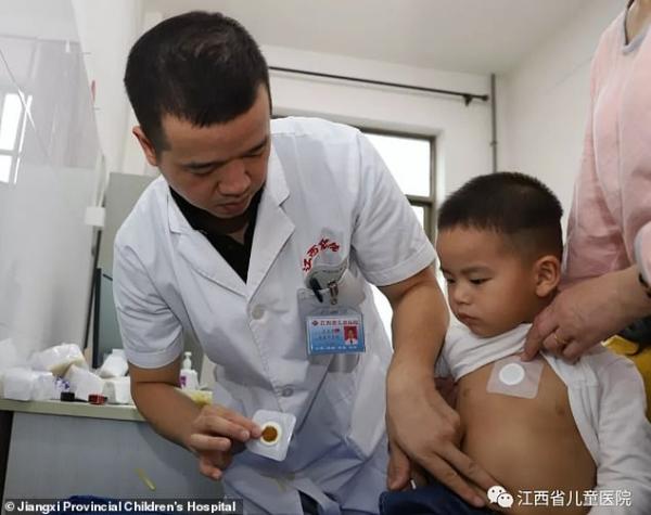 92 trẻ em bị tróc da, nổi mụn nước ở lưng khi điều trị bằng y học cổ truyền tại Trung Quốc 92 trẻ em bị tróc da, nổi mụn nước ở lưng khi điều trị bằng y học cổ truyền tại Trung Quốc