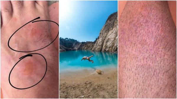 Ham sống ảo, Instagrammer bị phát ban và buồn nôn sau khi chụp ảnh gần hồ nước độc Ham sống ảo, Instagrammer bị phát ban và buồn nôn sau khi chụp ảnh gần hồ nước độc