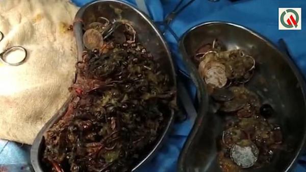 Bác sĩ lôi ra hơn 1,3 kg đồng xu và trang sức trong bụng một phụ nữ Ấn Độ Bác sĩ lôi ra hơn 1,3 kg đồng xu và trang sức trong bụng một phụ nữ Ấn Độ