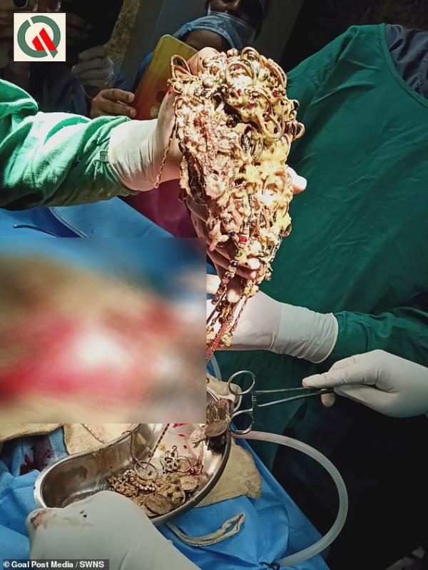 Bác sĩ lôi ra hơn 1,3 kg đồng xu và trang sức trong bụng một phụ nữ Ấn Độ Bác sĩ lôi ra hơn 1,3 kg đồng xu và trang sức trong bụng một phụ nữ Ấn Độ