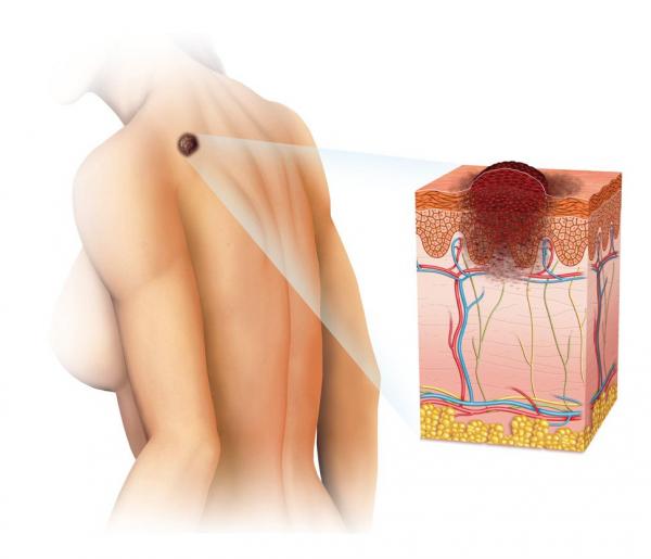 Trớ trêu: Những căn bệnh ung thư nguy hiểm nhất lại nhận được ít vốn tài trợ nghiên cứu nhất Trớ trêu: Những căn bệnh ung thư nguy hiểm nhất lại nhận được ít vốn tài trợ nghiên cứu nhất