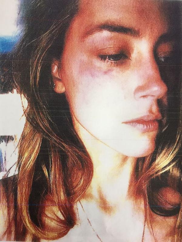 Johnny Depp tố cáo bị vợ cũ Amber Heard dí điếu thuốc đang cháy vào má Johnny Depp tố cáo bị vợ cũ Amber Heard dí điếu thuốc đang cháy vào má