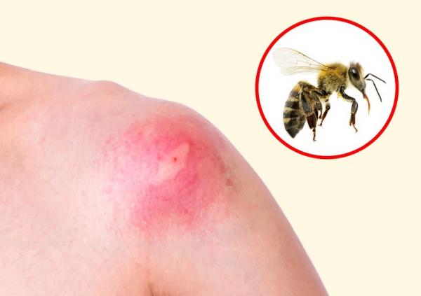 Nhìn vết cắn, 'điểm mặt chỉ tên' ngay loại côn trùng vừa cắn mình Nhìn vết cắn, 'điểm mặt chỉ tên' ngay loại côn trùng vừa cắn mình