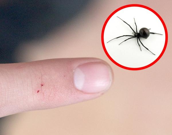 Nhìn vết cắn, 'điểm mặt chỉ tên' ngay loại côn trùng vừa cắn mình Nhìn vết cắn, 'điểm mặt chỉ tên' ngay loại côn trùng vừa cắn mình